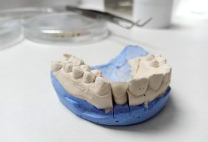 Krunica - Protetika zuba