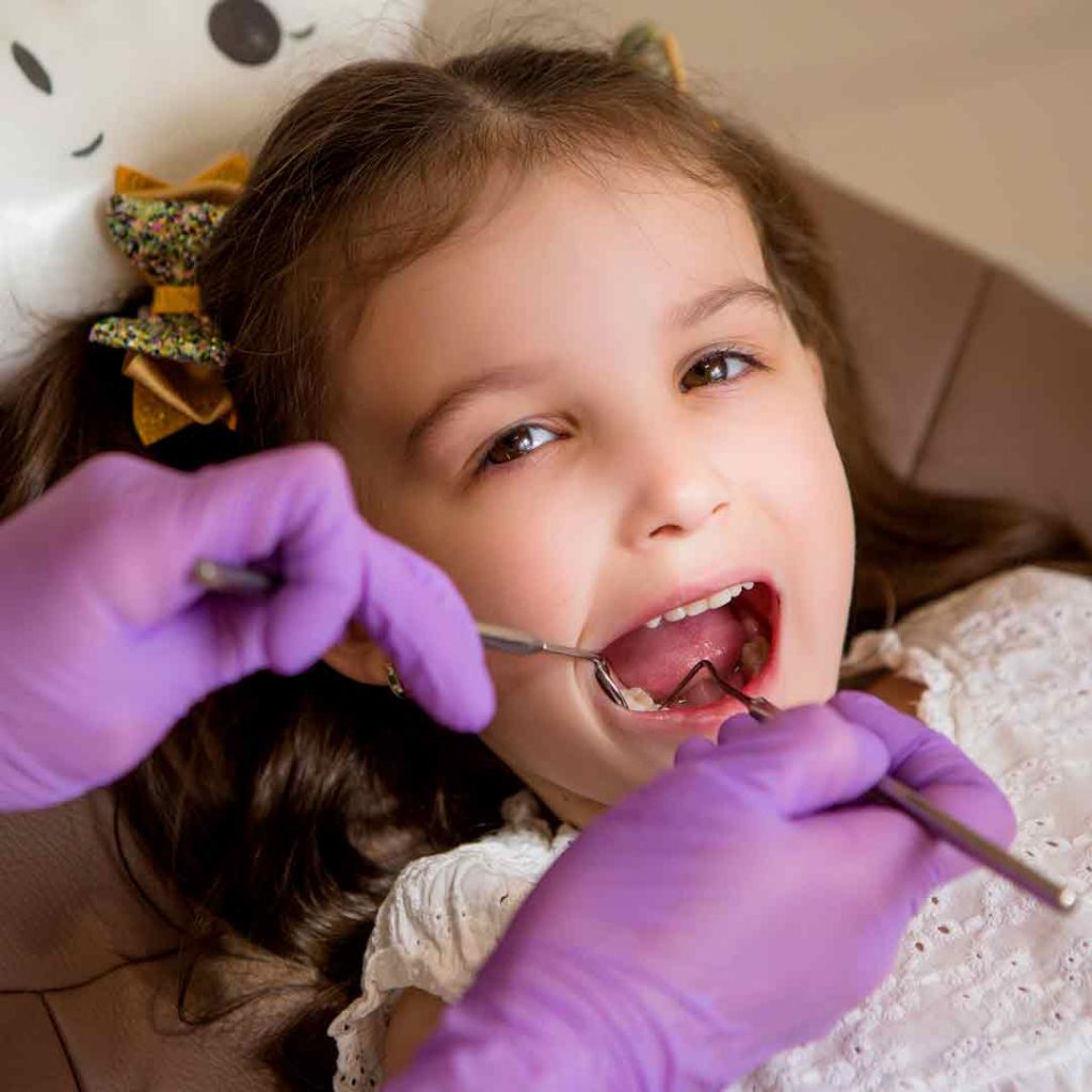 Zalivanje fisura zuba i prevencija karijesa